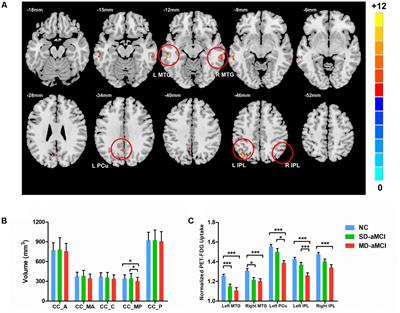 Decreased Bilateral FDG-PET Uptake and Inter-Hemispheric Connectivity in Multi-Domain Amnestic Mild Cognitive Impairment Patients: A Preliminary Study